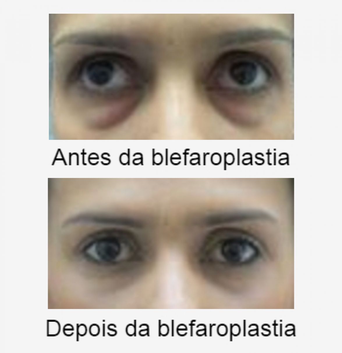Operação aos olhos, antes e depois